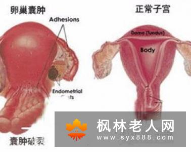 卵巢囊肿都有哪些临床表现症状