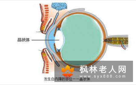 吃太咸可引起白内障