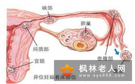 我输卵管一边堵塞，一边有些粘连，该这么治疗？