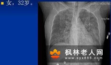 针灸的抗缺血缺氧抗自由基